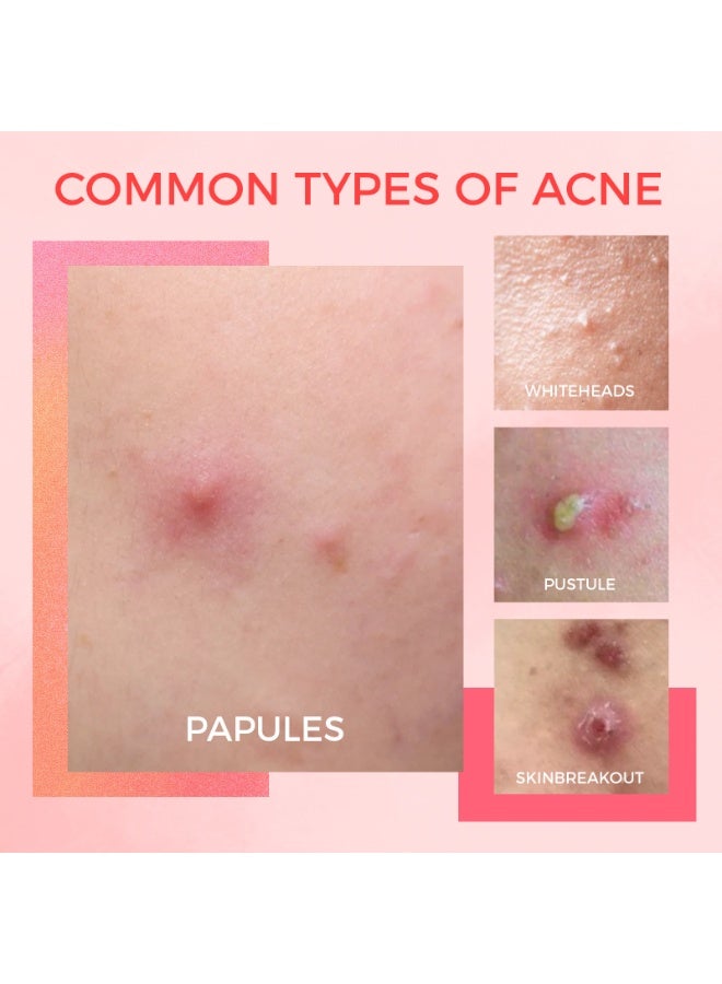 أوكييا ماء لعلاج حب الشباب بحمض الساليسيليك بتركيز 2%، للتحكم في الزيوت، وإصلاح البشرة، وتخفيف آثار حب الشباب، للبشرة الحساسة، 10 مل - Image 4